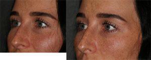 Restylane Filler to Tear Troughs by Dr. Otto J. Placik, Chicago Plastic Surgeon (2)