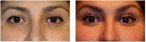Restylane Filler to Tear Troughs to help with under eye circles by Dr. Otto J. Placik, Chicago Plastic Surgeon (1)