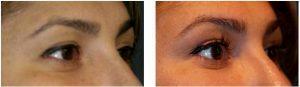 Restylane Filler to Tear Troughs to help with under eye circles by Dr. Otto J. Placik, Chicago Plastic Surgeon (2)