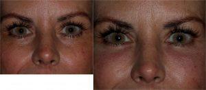 Restylane Filler to the Tear Troughs (under eyes) by Dr. Otto J. Placik, Chicago Plastic Surgeon (1)