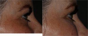 Restylane Filler to the Tear Troughs (under eyes) by Dr. Otto J. Placik, Chicago Plastic Surgeon (2)