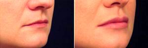 Restylane For Lip Augmentation Before & After With Dr. Michael Law, MD, Raleigh-Durham Plastic Surgeon