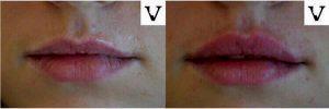 Restylane For Lips By Masha Banar, Injector In Boston