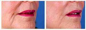 Restylane For Nasolabial Folds And Marionette Lines Before & After With Doctor Rod J. Rohrich, MD, Dallas Plastic Surgeon