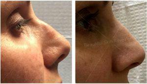 Restylane For Nose By Paul M. Friedman, MD, Dermatologist In Houston, Texas