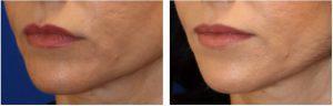 Restylane Injections To The Marionette Lines And Corners Of The Lower Lip By Dr. Matthew Richardson, MD, Frisco TX Facial Plastic Surgeon (1)