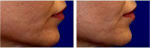 Restylane Injections To The Marionette Lines And Corners Of The Lower Lip By Dr. Matthew Richardson, MD, Frisco TX Facial Plastic Surgeon (2)