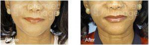 Restylane Silk Injected To Enhance The Lips By Kristin A. Boehm, M.D., FACS, Plastic Surgeon In Atlanta, GA