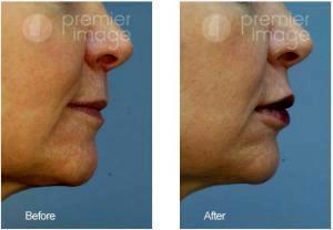 Restylane Silk Injected To The Lips By Kristin A. Boehm, M.D., FACS, Plastic Surgeon In Atlanta, GA