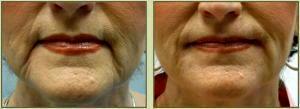 Restylane To Lips By Dr. Tricia Brown, Dermatologist In Houston, TX (10)