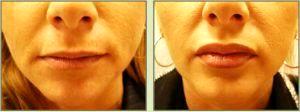 Restylane To Lips By Dr. Tricia Brown, Dermatologist In Houston, TX (11)