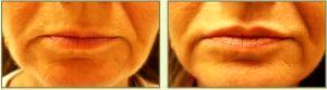 Restylane To Lips By Dr. Tricia Brown, Dermatologist In Houston, TX (12)