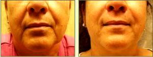 Restylane To Lips By Dr. Tricia Brown, Dermatologist In Houston, TX (13)