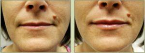Restylane To Lips By Dr. Tricia Brown, Dermatologist In Houston, TX (2)