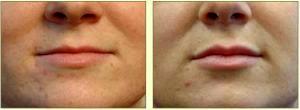 Restylane To Lips By Dr. Tricia Brown, Dermatologist In Houston, TX (3)