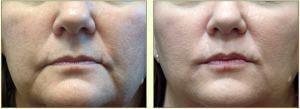 Restylane To Lips By Dr. Tricia Brown, Dermatologist In Houston, TX (5)