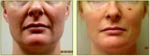 Restylane To Lips By Dr. Tricia Brown, Dermatologist In Houston, TX (6)