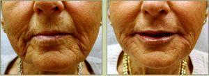 Restylane To Lips By Dr. Tricia Brown, Dermatologist In Houston, TX (7)