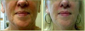Restylane To Lips By Dr. Tricia Brown, Dermatologist In Houston, TX (8)