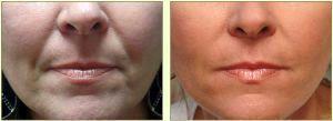 Restylane To Lips By Dr. Tricia Brown, Dermatologist In Houston, TX (9)