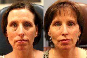 Restylane To Lower Eyes By Dr. Jeffrey Raval, MD, Denver, CO Plastic Surgeon