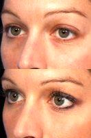 Restylane To Tear Troughs (under Eyes) With Dr. Grant Stevens, MD, Los Angeles Plastic Surgeon