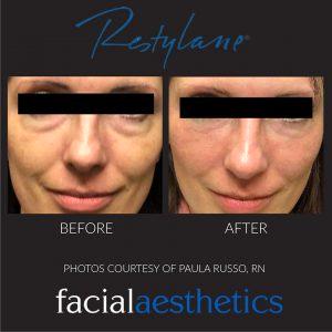 Restylane To The Tear Troughs At Facial Aesthetics In Denver