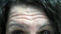 Restylane Vs Botox For Forehead