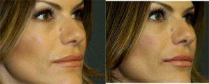 Restylane to Nasolabial Folds & Tear Troughs. Juvederm Voluma to Cheeks, Lips & Oral Commisure by Dr. Otto J. Placik, Chicago Plastic Surgeon (1)