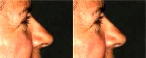 Restylane to Tear Troughs by Dr. Otto J. Placik, Chicago Plastic Surgeon (1)