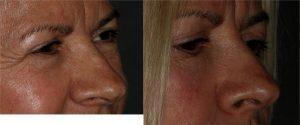 Restylane to Tear Troughs by Dr. Otto J. Placik, Chicago Plastic Surgeon (2)