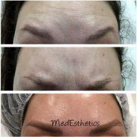 Safe Forehead Botox Before And After