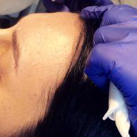 Safety Of Botox Injections In Forehead