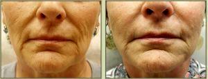Sculptra 6 Months After Treatment By Dr. Tricia Brown, Dermatologist In Houston, TX