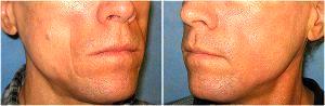 Sculptra injections by Dr. Lorri Cobbins, Plastic surgeon in Chicago, Illinois (1)