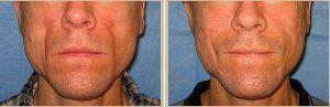 Sculptra injections by Dr. Lorri Cobbins, Plastic surgeon in Chicago, Illinois (3)