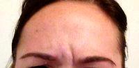 Static Lines Appear Between Your Eyebrows In An Area Called The Glabella