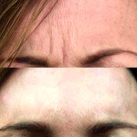 The Amount Of Botox Needed Varies Depending On The Strength And Size Of The Corrugator Muscles