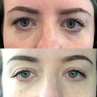 The Botox Brow Lift Explained