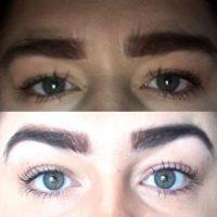 The Chemical Browlift Before And After