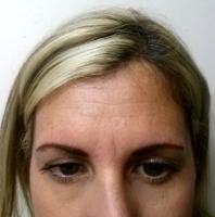 The Decision Of Units Of Botox For Forehead Is Usually Made By Doctors