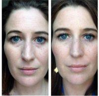 The Effects Of Botox Injections Typically Last From 3 To 4 Months