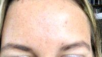 The Frontalis Causes Forehead Wrinkle