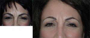 The Injection Site For The Botox® Was The Glabella By Dr. Patrick Schaner