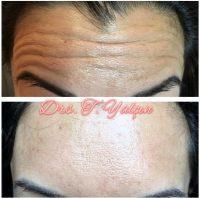 The Maximum Effect Of Botox Usually Occurs At About 10-14 Days