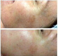 The Most Common Side Effect When Botox Is Used For Crow's Feet Is Swollen Eyelids,