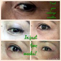 Treat You Under Eye Wrinkles