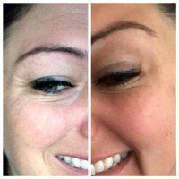 Treating Crows Feet With Botox