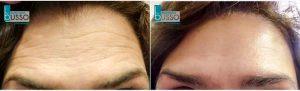 Treating Forehead Lines With Botox Cosmetic With Dr. Mariano Busso, MD, Miami Dermatologic Surgeon