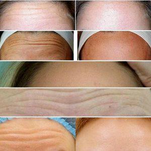 Treating Forehead Wrinkles With Botox